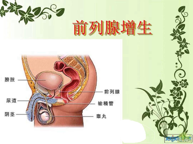 夜尿增多等症状,经过药物治疗效果不佳,或者前列腺增生引起膀胱功能