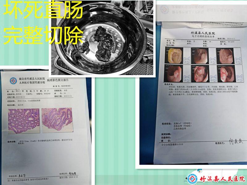 腹腔镜直肠癌根治性切除手术填补竹溪空白